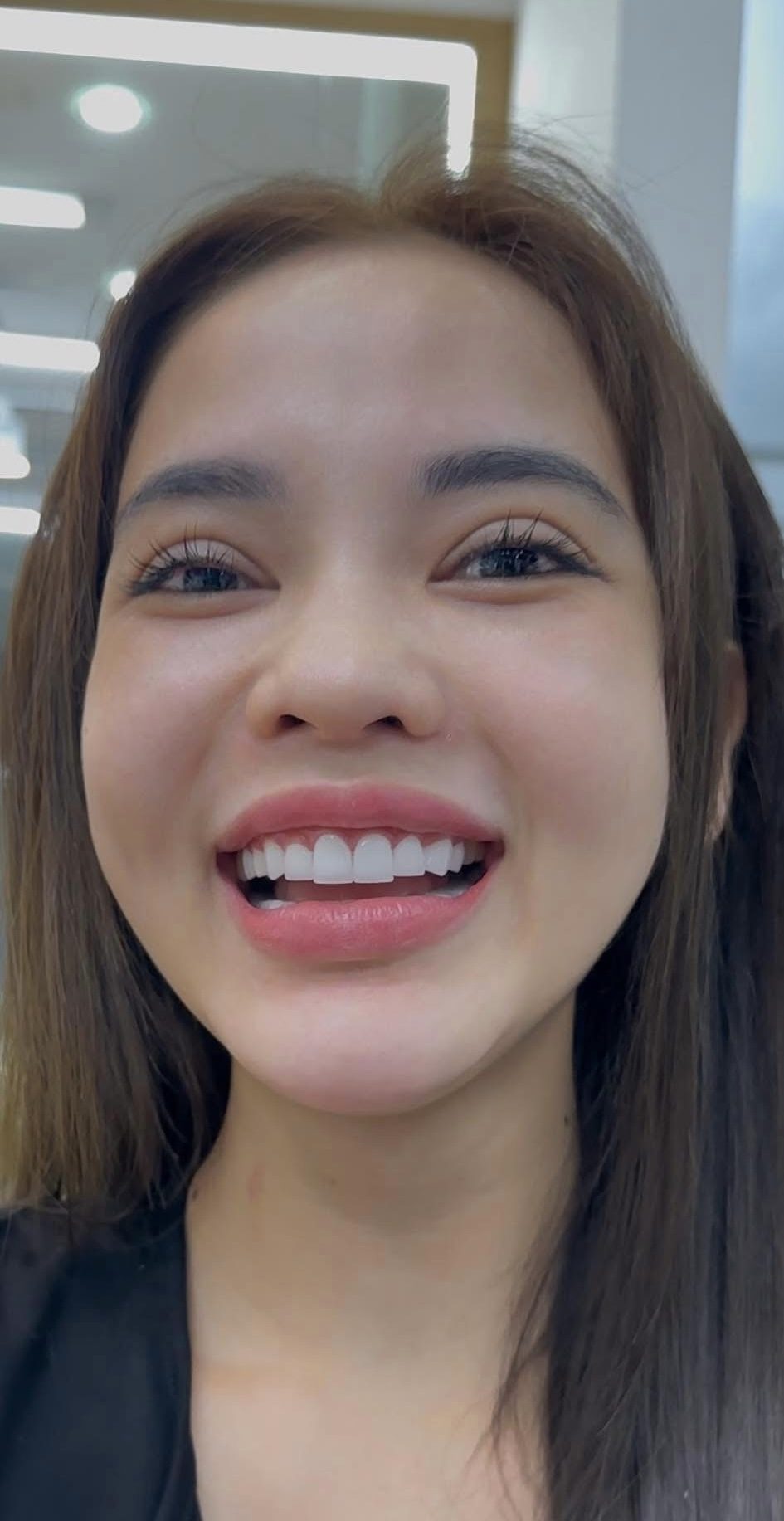 20 Răng Zirconia